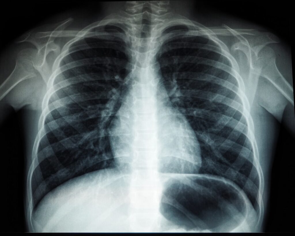 El cáncer de pulmón: un peligro silencioso Foto de Umanoide en Unsplash (https://unsplash.com/@umanoide)